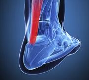 Achilles Tendonitis