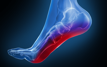 Plantar Fasciitis